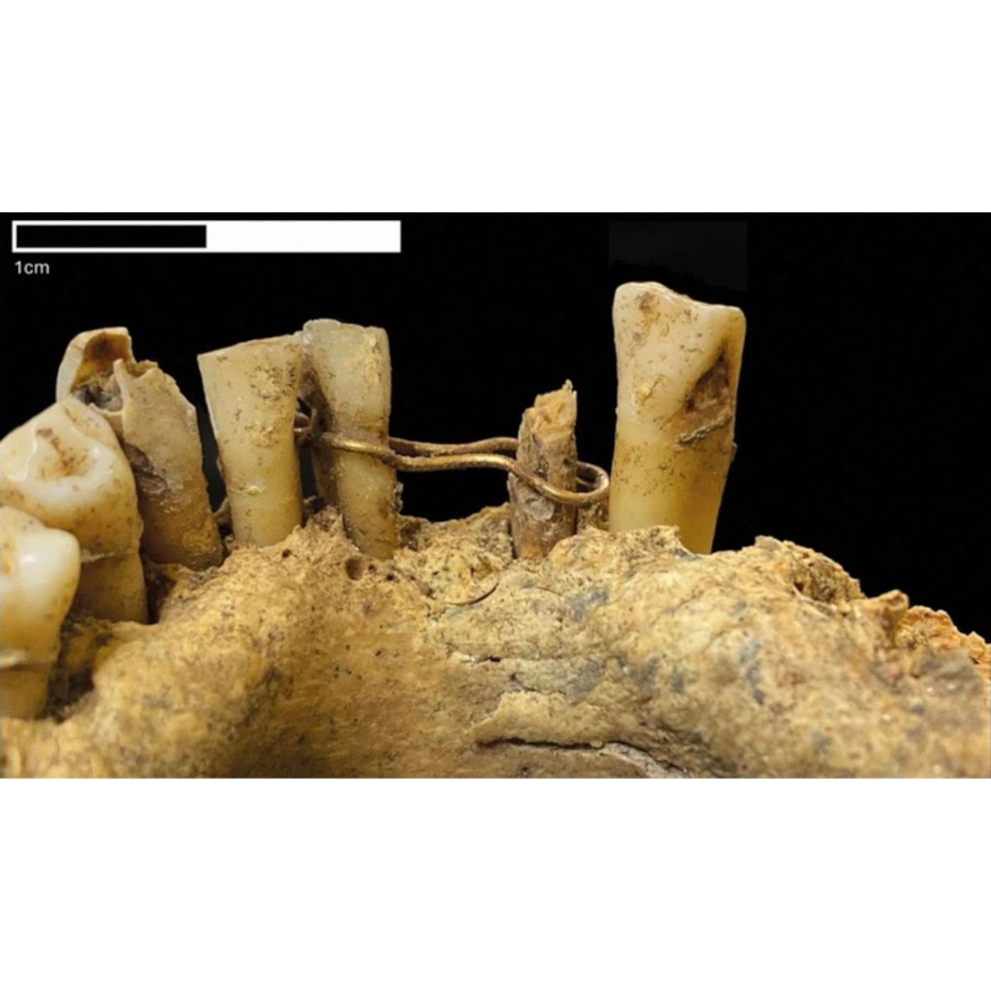Medieval Jaw Reveals Scotland's First Known Dental Bridge Made from 20-Carat Gold | Ancient Origins episode artwork